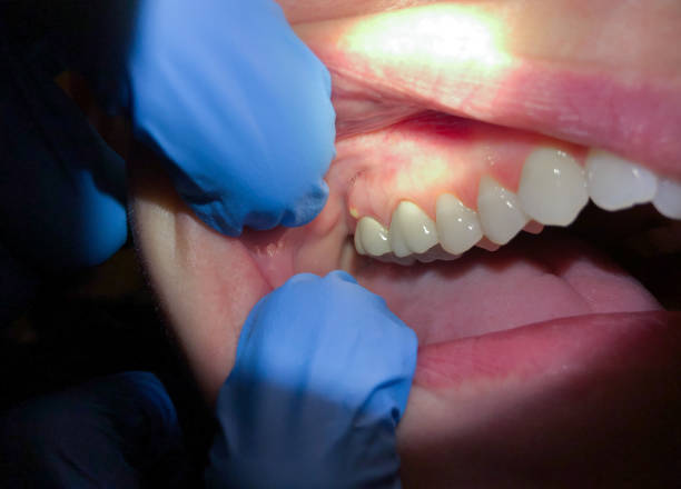 Best Emergency Care for Gum Disease in Pryor Creek, OK