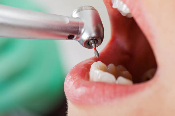 Best Knocked-Out Tooth (Avulsed Tooth) Treatment in Pryor Creek, OK